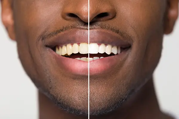 টুথ হোয়াইটেনিং (দাঁত সাদা করা) - Azam's Dental Care