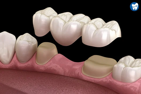 Cap, Bridge, Denture - Azam's Dental Care