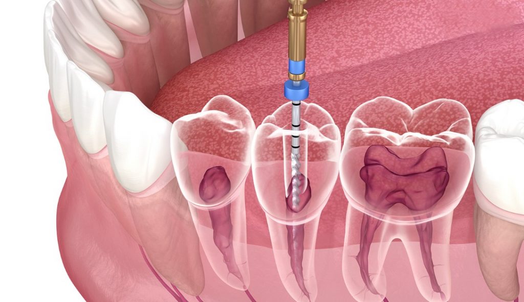 Root Canal Treatment - Azam's Dental Care