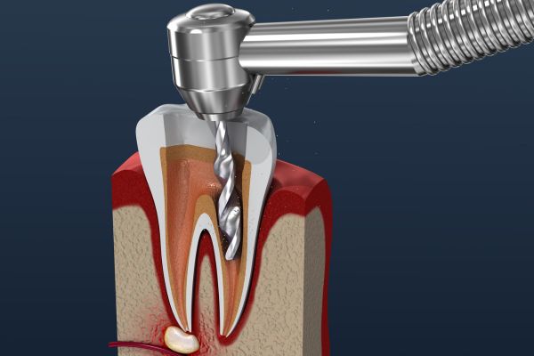 Surgical Endodontics - Azam's Dental Care