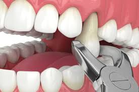 Tooth Extraction - Azam's Dental Care