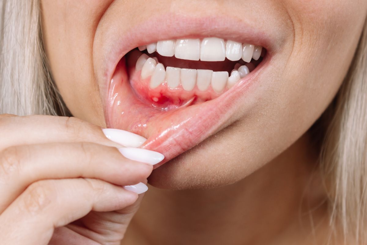 Treatment for Mouth/Tongue Ulcers and Oral Cysts - Azam's Dental Care